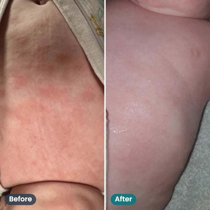 Before and after: baby skin, customer photo (Tegan)