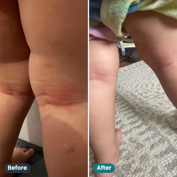 Before and after: behind the knees, customer photo (Lazara Storm)